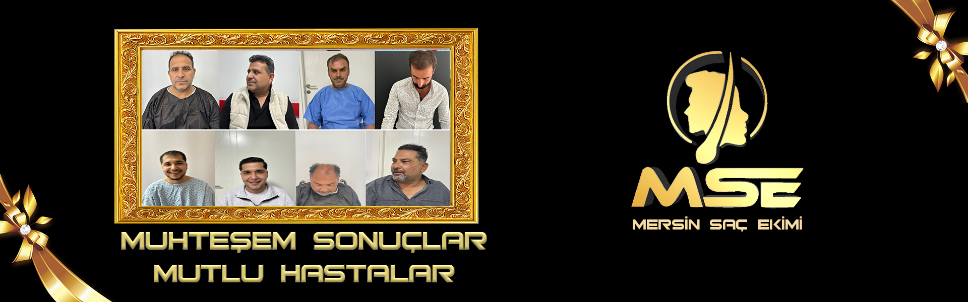 2026 - Mersin Saç Ekimi