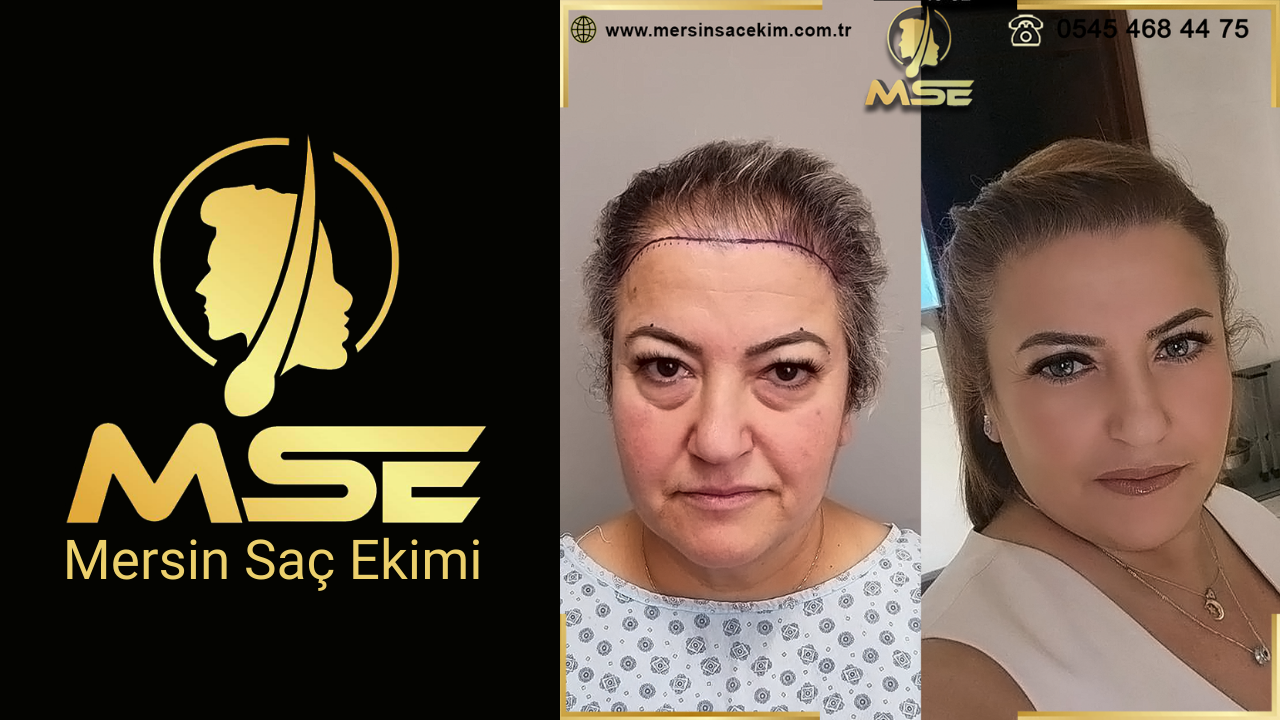 Mersin Saç Ekimi